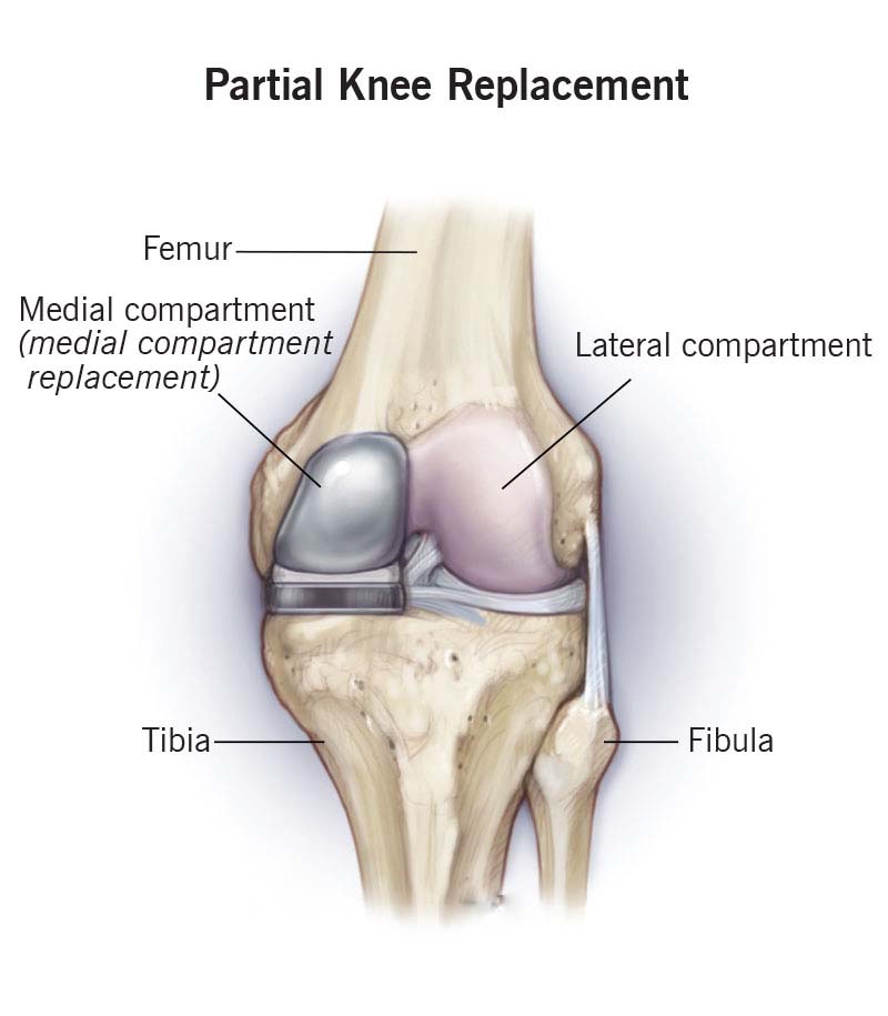 Partial Knee Replacement image