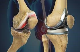 total knee replacement in hsr layout, bangalore