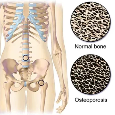 Osteoporosis 