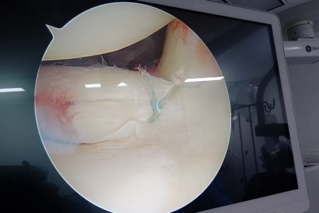 Meniscus Repair in HSR layout, BTM, koramangala | Dr Akshay shetty