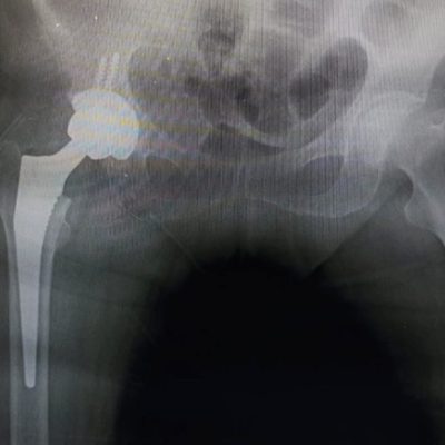 Total Hip Replacement in HSR Layout