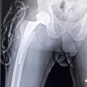 Best orthopedic surgeon for partial hip replacement in HSR layout