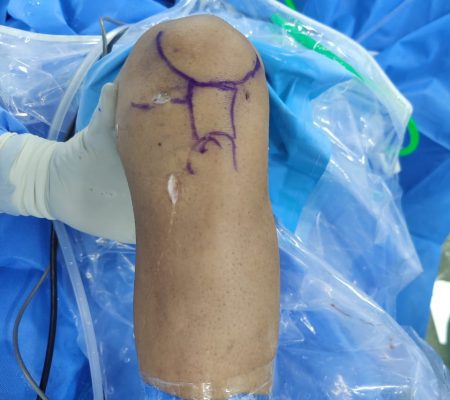 Knee Arthroscopy image