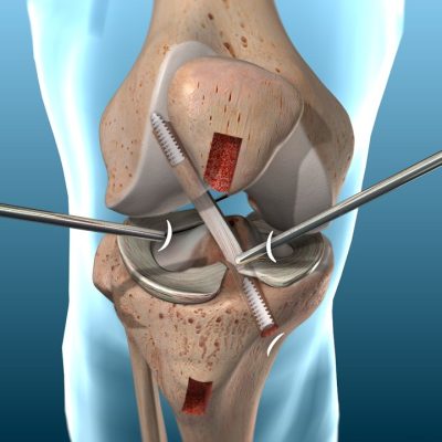 ACL Reconstruction