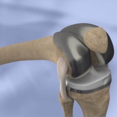 Knee Replacement